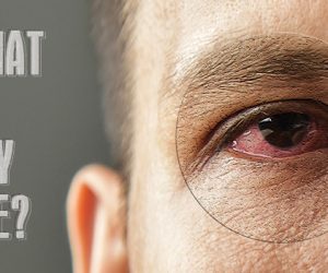 What Is Dry Eye?